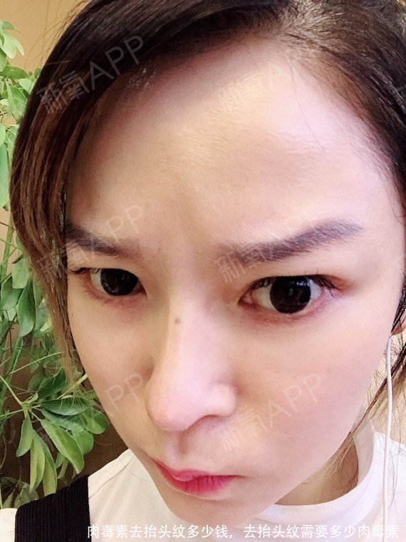 肉毒素去抬头纹多少钱，去抬头纹需要多少肉毒素 