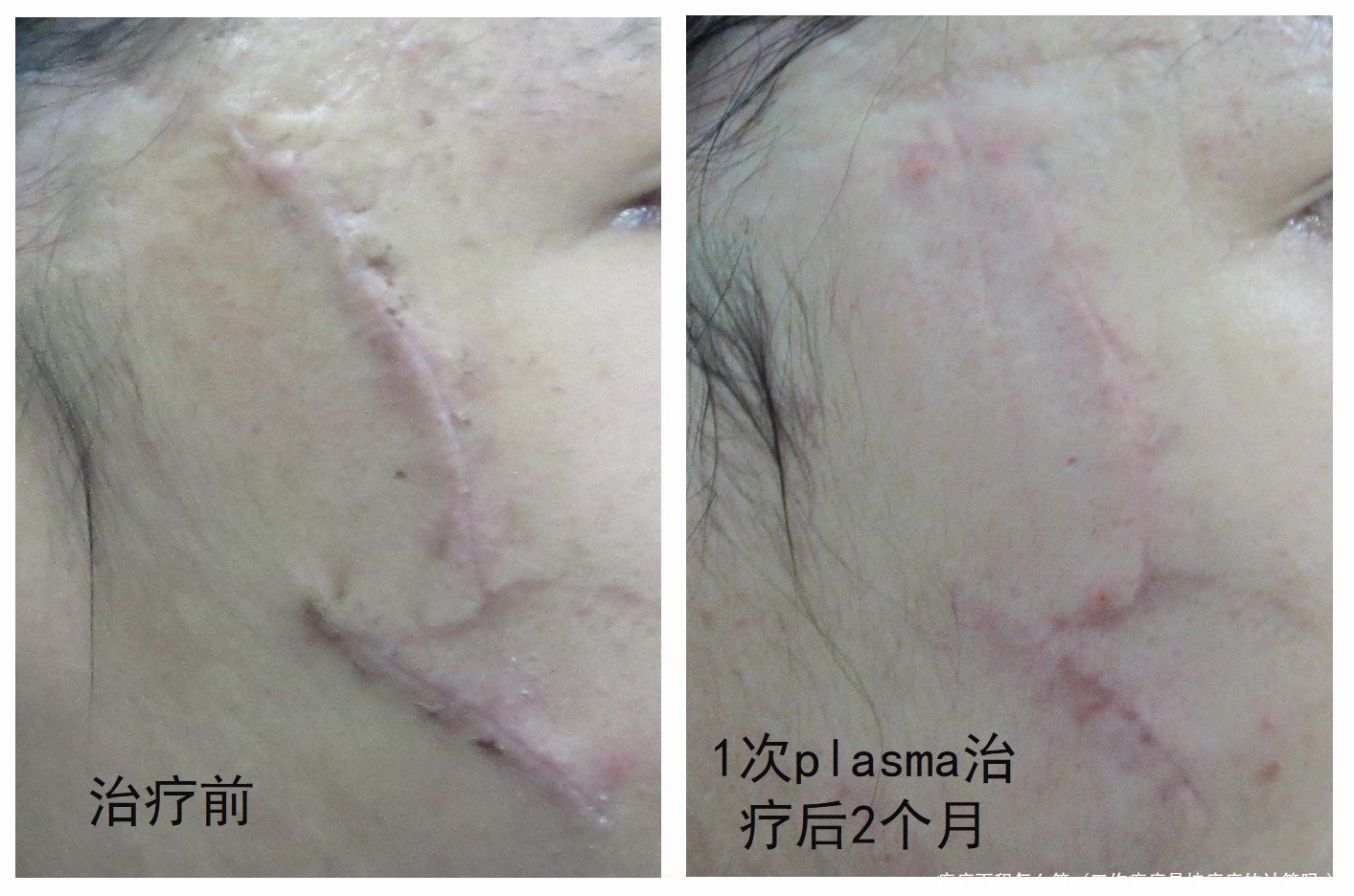 瘢痕面积怎么算(工伤瘢痕是按疤痕的计算吗)