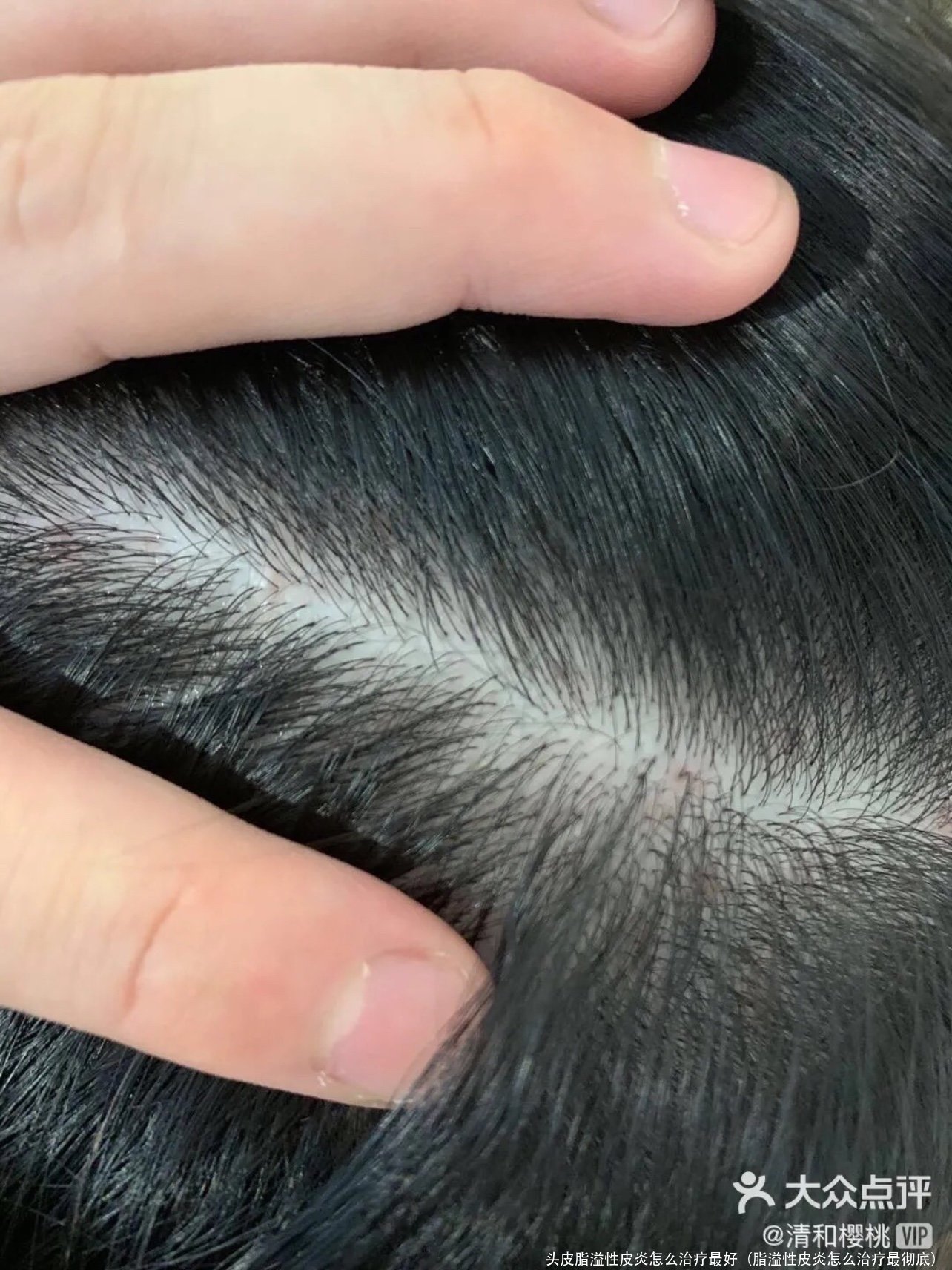 头皮脂溢性皮炎怎么治疗最好(脂溢性皮炎怎么治疗最彻底)