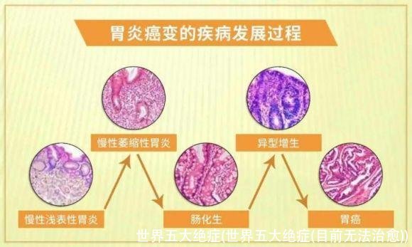 世界五大绝症(世界五大绝症(目前无法治愈))