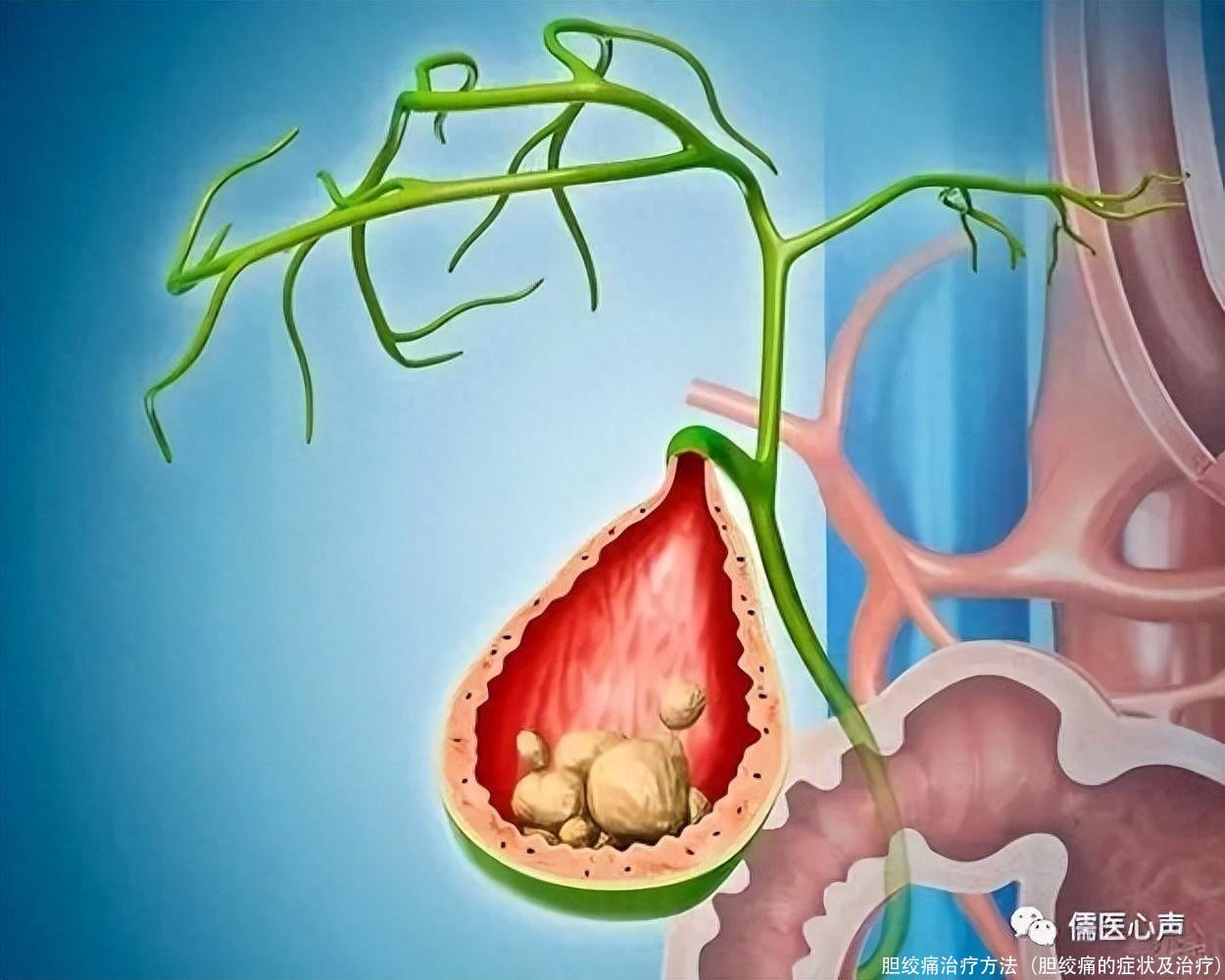 胆绞痛治疗方法(胆绞痛的症状及治疗)