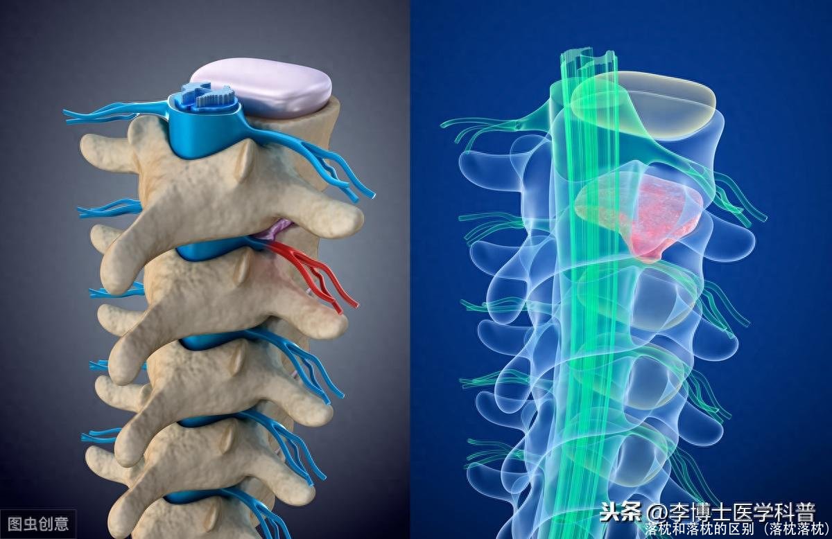 落枕和落枕的区别（落枕落枕）