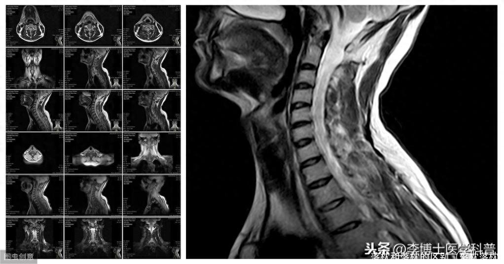 落枕和落枕的区别（落枕落枕）