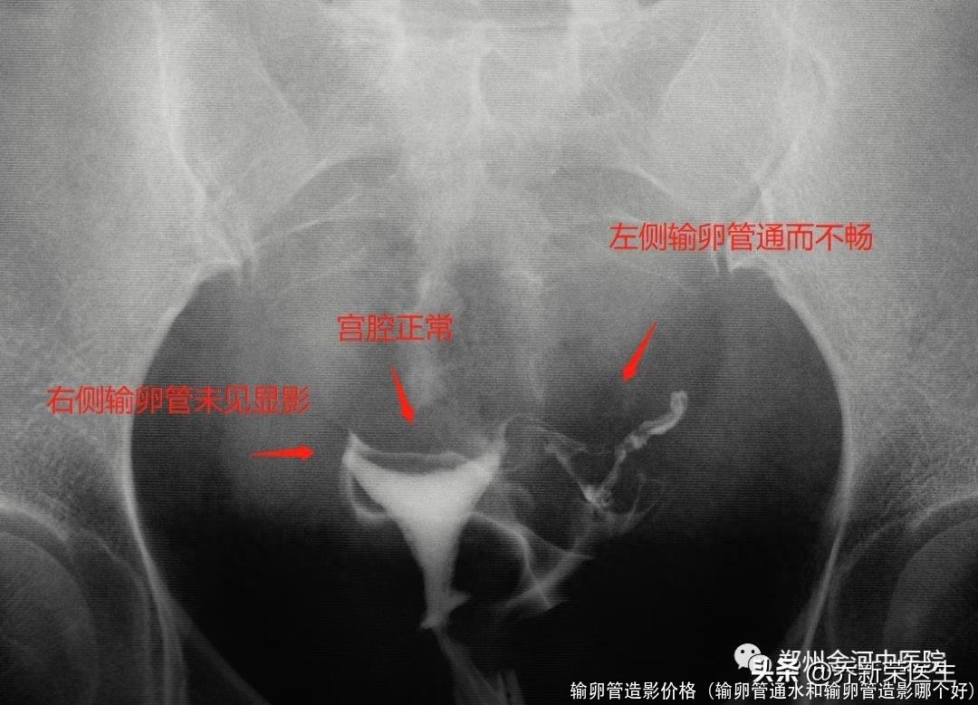 输卵管造影价格(输卵管通水和输卵管造影哪个好)